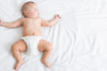 Health Experts are Warning Parents about the Measles
